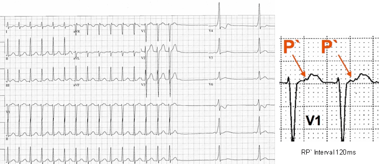 Orthodromic reciprocating tachycardia induced in a patient with left lateral accessory pathway (AP)