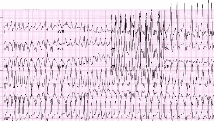 Atrial fibrillation in a patient with WPW syndrome with rapid ventricular rate; resulted in aborted sudden cardiac death (SCD)