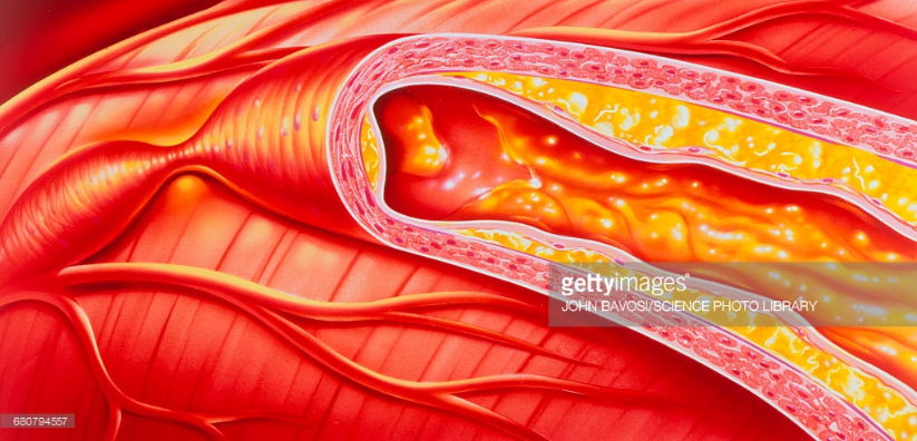 Xơ vữa động mạch vành là gì | Cơ chế hình thành mảng xơ vữa