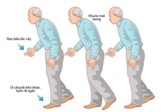 Tiêu chuẩn chẩn đoán Lâm sàng bệnh Parkinson của MDS